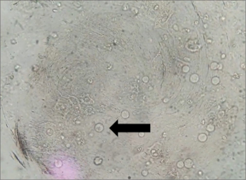 Urine microscopic examination showing field full of Trichomonas vaginalis (black arrowhead).
