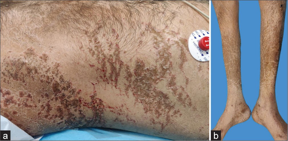 (a) Irregular, hyperpigmented scales on the trunk, with many showing a moist, erythematous base, and (b) irregular, hyperpigmented scales over bilateral lower limbs.