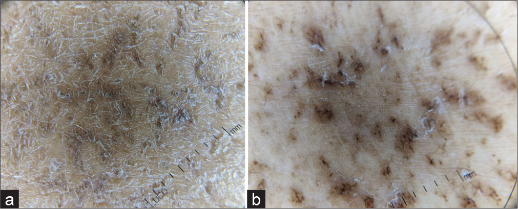 Irregular areas of hyperpigmentation with a surrounding halo of light brown pigmentation. There were areas of superficial whitish scales over the skin (Using hand-held polarized dermatoscope IDS1100, ILLUCO, KOREA). (a) Non-polarized mode (scales are more prominent) and (b) polarized mode (pigmentary changes are more prominent).