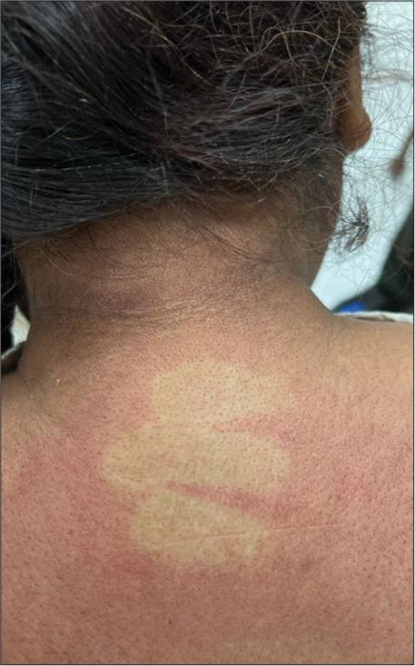 Blanching erythema over the nape of the neck.