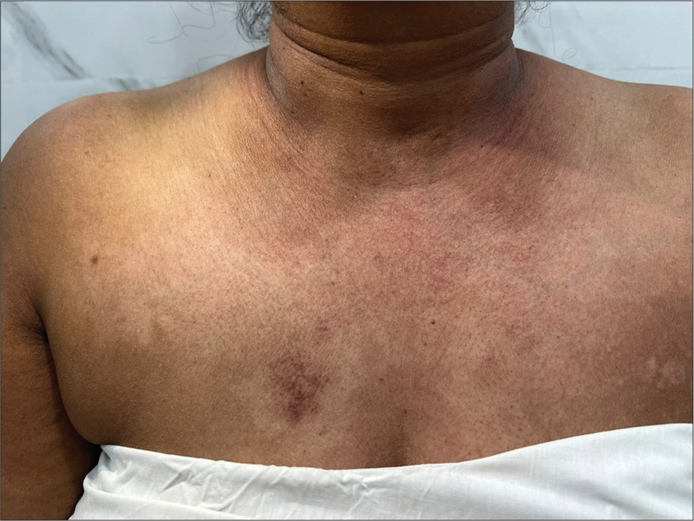 Hypopigmented patches interspersed with erythematous macules over the chest forming a “red on white” lesion pattern.