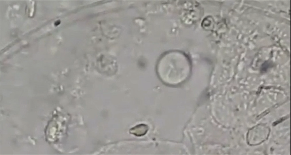 Urine microscopic examination of same patient-Trichomonas vaginalis-internal structure is also visible.
