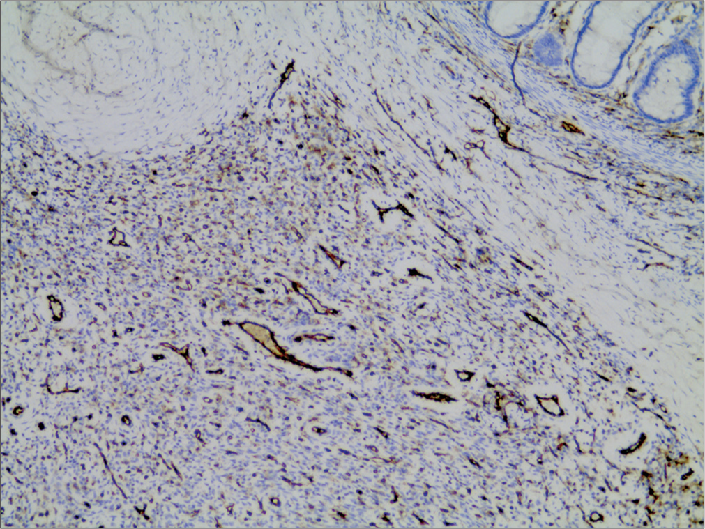 Immunohistochemical staining with CD31. Proliferating vascular structures are seen in brown (immunoperoxidase, ×100).