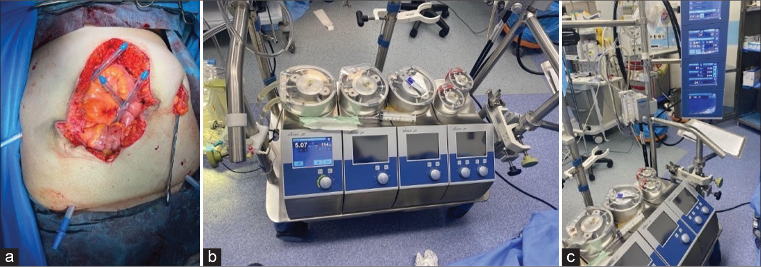 (a) An intraoperative view during a hyperthermic intraperitoneal chemotherapy (HIPEC) procedure, showcasing the abdominal cavity post-cytoreductive surgery. Here, inflow and outflow catheters are placed, indicating the preparation for the HIPEC phase, where heated chemotherapeutic agents will be circulated to target microscopic residual cancer cells within the peritoneal cavity. (b and c) The machinery used in HIPEC. They display the perfusion system which controls the temperature and flow of the chemotherapeutic agent within the peritoneal cavity, a crucial component in the HIPEC procedure.