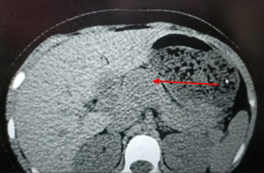 Contrast-enhanced computed tomography of the abdomen image showing hypodense lesion at junction of the head and body of the pancreas (red arrow).