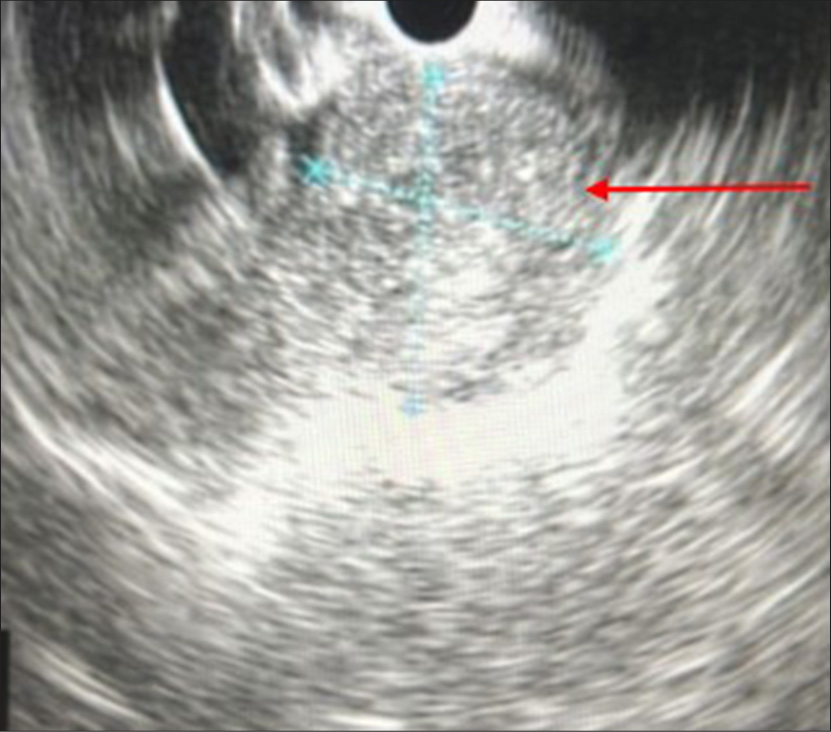 Endoscopic ultrasound showing heteroechoic lesion at the pancreatic neck (red arrow). The blue cross indicates the diameter of the swelling.