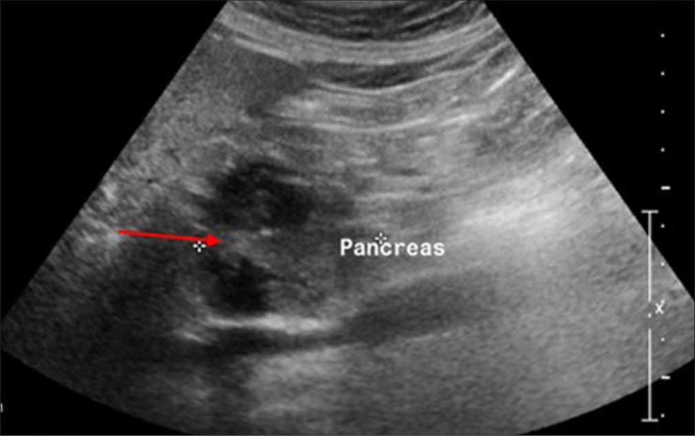 Ultrasound of the abdomen showing heteroechoic lesion (red arrow) in the pancreatic head with few hypoechoic areas within.