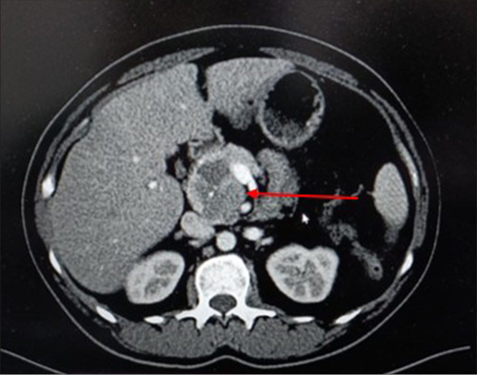 Contrast-enhanced computed tomography of the abdomen showing ill-defined hypodense lesion (red arrow) with predominantly solid and minimal cystic components, in the head of pancreas. The solid component shows late arterial enhancement.